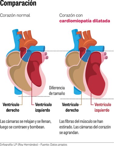Científicos establecen relación entre el cáncer y la cardiomiopatía dilatada