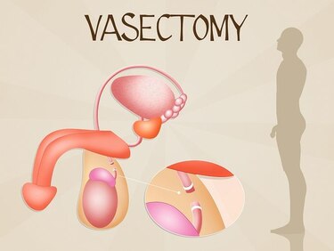 Nueve mitos de la vasectomía