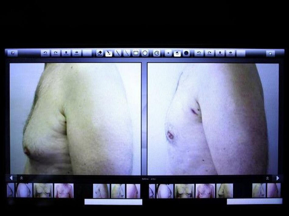 Ginecomastia: cuando las mamas crecen en el varón