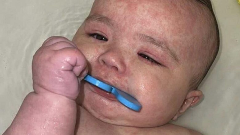 Cómo Canadá se convirtió en el epicentro del sarampión en Norteamérica