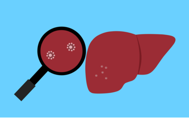 Hepatocarcinoma: prevalencia, diagnóstico y nuevas terapias