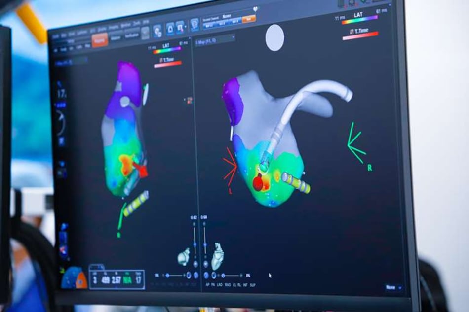 De clínicas privadas a la CSS: tecnología 3D llega al quirófano para tratar taquicardias