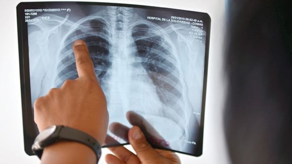 Plan contra la tuberculosis