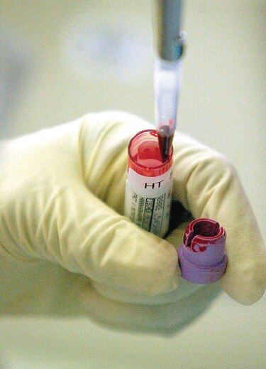 Hallan 89 genes implicados en el riesgo de sufrir un ictus