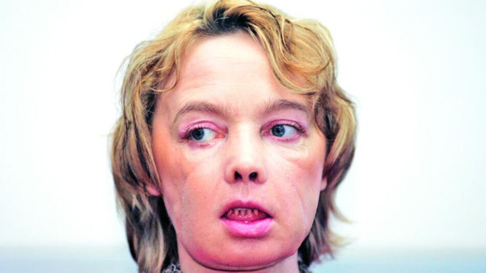 Primera paciente con trasplante de rostro fallece