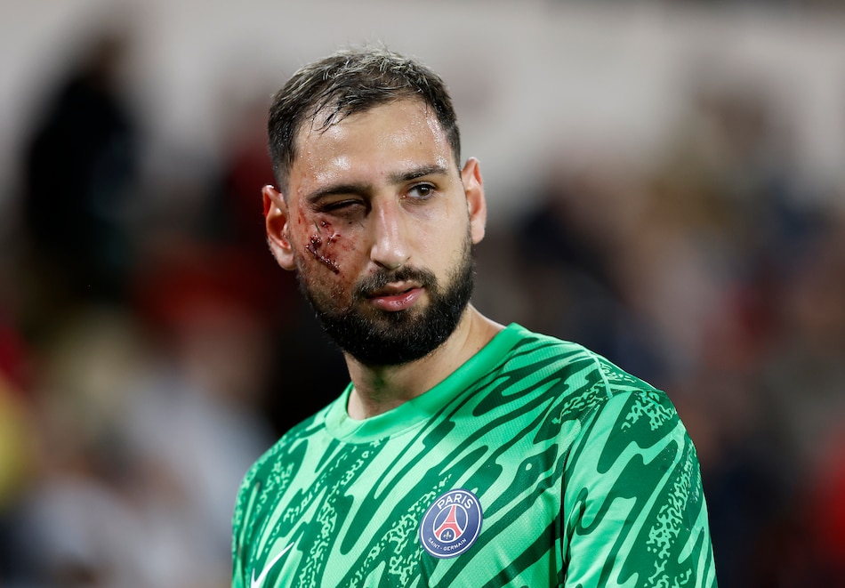Donnarumma, sustituido por un golpe en la cara