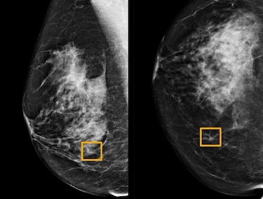 La inteligencia artificial, eficaz para diagnosticar cáncer de mama
