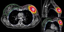 Radioterapia en cinco sesiones logra control del cáncer de mama en 122 pacientes