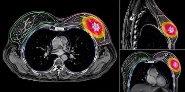 Radioterapia en cinco sesiones logra control del cáncer de mama en 122 pacientes
