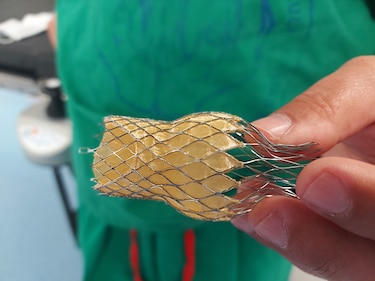 Médicos panameños realizan el primer implante de válvulas tricúspides del corazón en Centroamérica