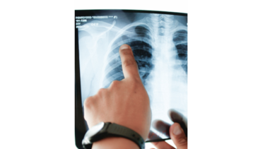 Tuberculosis, una enfermedad infecciosa que aún no se ha erradicado en Panamá