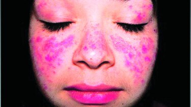 La autoagresión del lupus