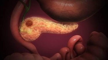 Diseñalan unas células T que se sobrealimentan a sí mismas para luchar contra el cáncer de páncreas