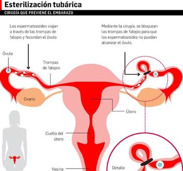 Reclaman igualdad en edad para esterilizarse