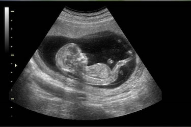 El Covid-19 aumenta fuertemente la posibilidad de muerte fetal, según estudio