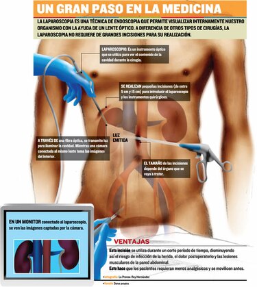 Trasplante de riñón por laparoscopia