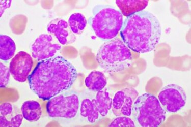 Nuevo objetivo para una posible terapia contra la leucemia