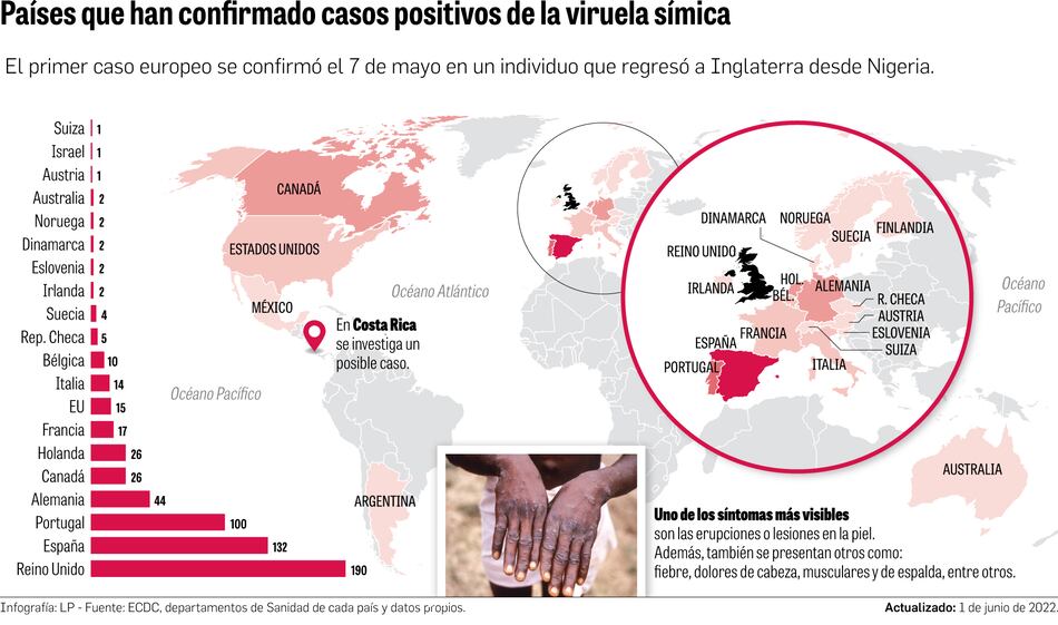 Brote de viruela símica: ¿qué razones hay para ser optimista?