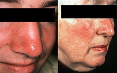 ¿Por qué tienes la cara tan roja?