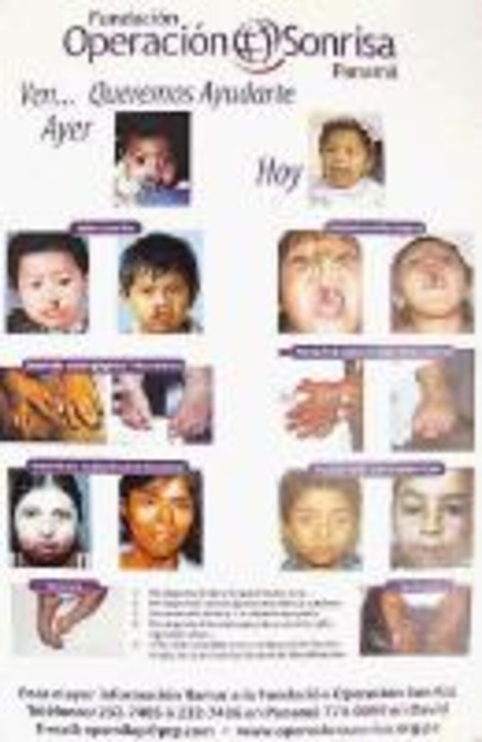 Operación Sonrisa busca a sus pacientes