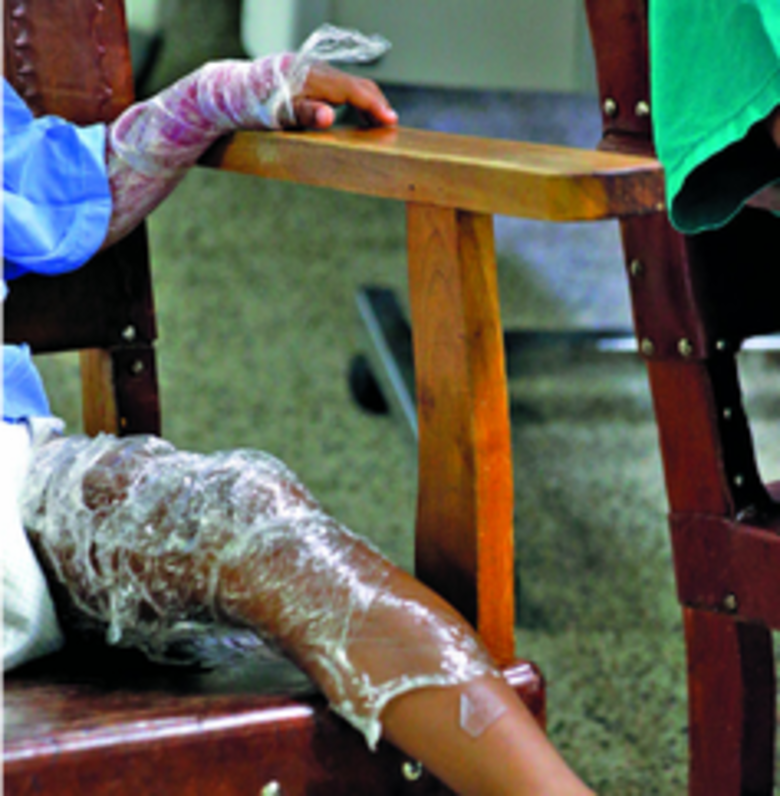 Ocho niños quemados por juegos pirotécnicos