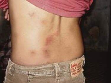 Parece acné, pero no es