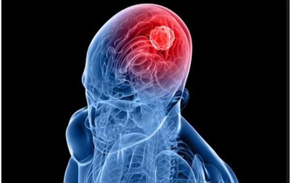 Estudio prevé menos radiaciones para cáncer de cerebro
