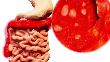 Inflamación intestinal