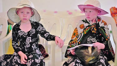Albinos africanos sufren persecución
