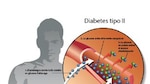 La presencia de la diabetes