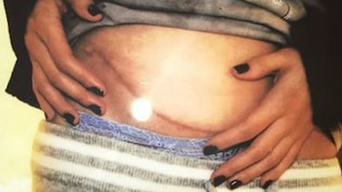 Selena Gómez se somete a trasplante de riñón por lupus