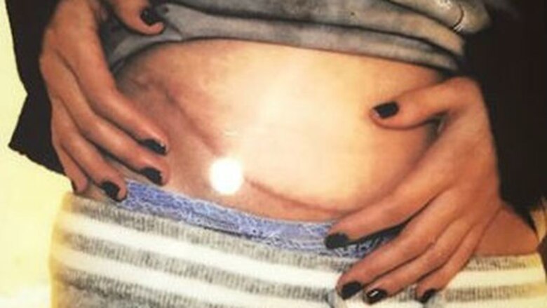 Selena Gómez se somete a trasplante de riñón por lupus