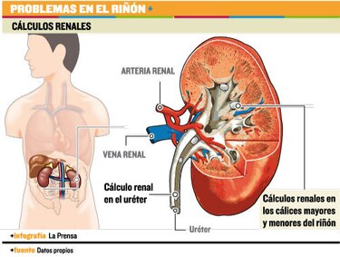 Cómo se crean los cálculos renales
