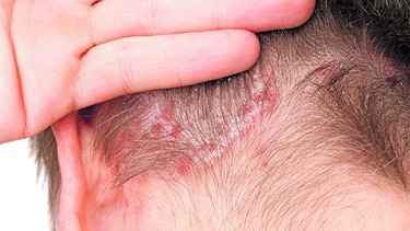 Pasos por la psoriasis