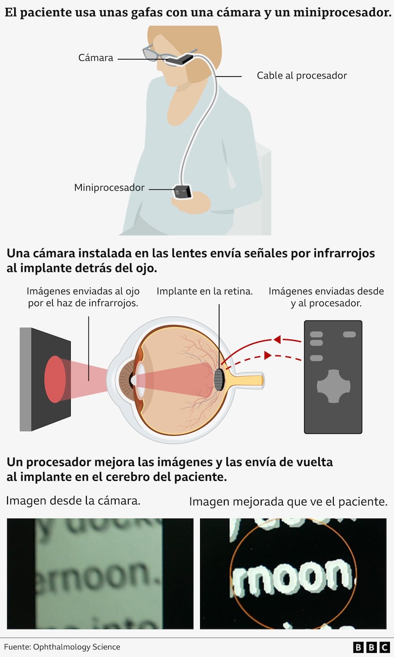 El innovador implante ocular que ayuda a pacientes ciegos a volver a leer