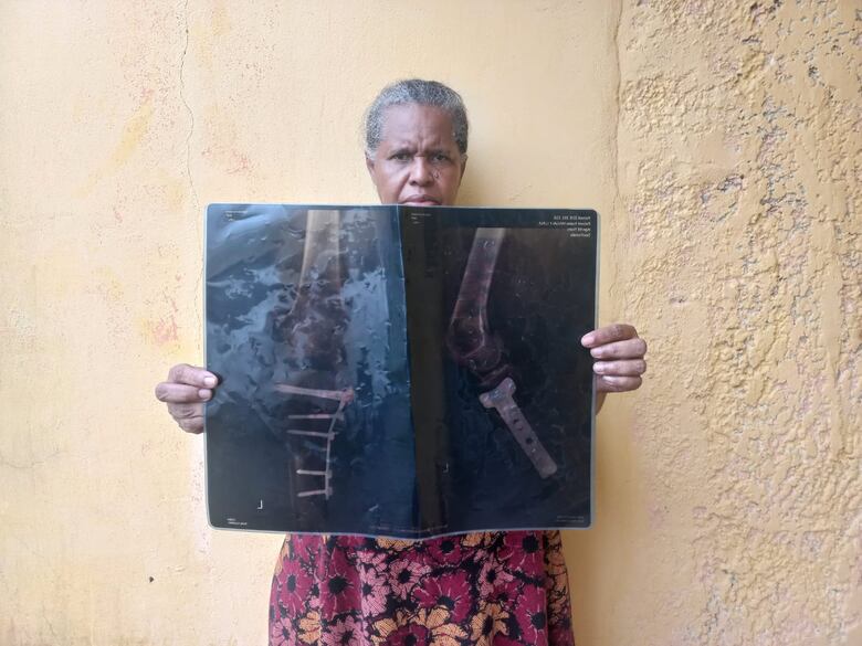 Entre el abandono y el dolor: sobrevivientes de atropellos por metrobús exigen justicia