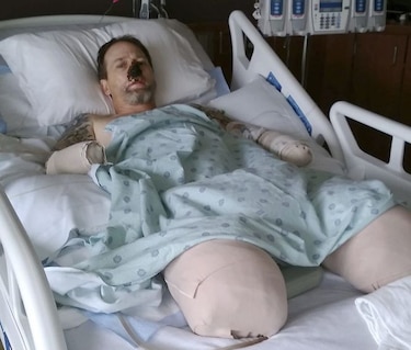 Hombre sufre amputación de extremidades por lamida de perro