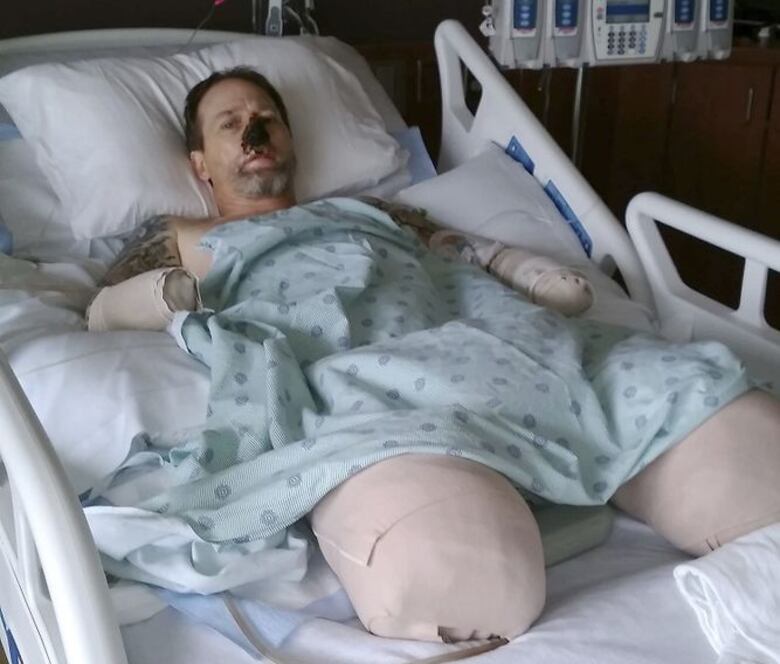 Hombre sufre amputación de extremidades por lamida de perro