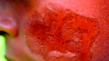 Crema tópica, efectiva contra la leishmaniasis