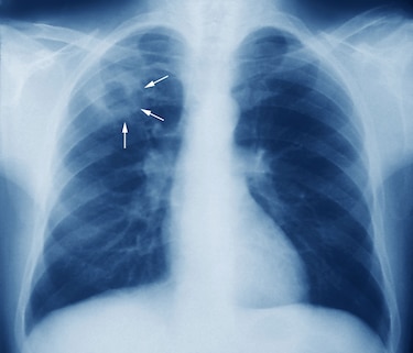 El número de muertos por tuberculosis sube por la pandemia de Covid-19