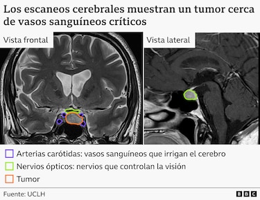 El primer paciente del mundo al que le retiraron un tumor en el cerebro con ayuda de la IA