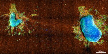 Un estudio arroja luz sobre la capacidad de las células cancerosas para migrar