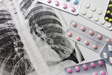 Tratamiento para la tuberculosis pasará de 6 a 3 meses con la llegada de un nuevo fármaco