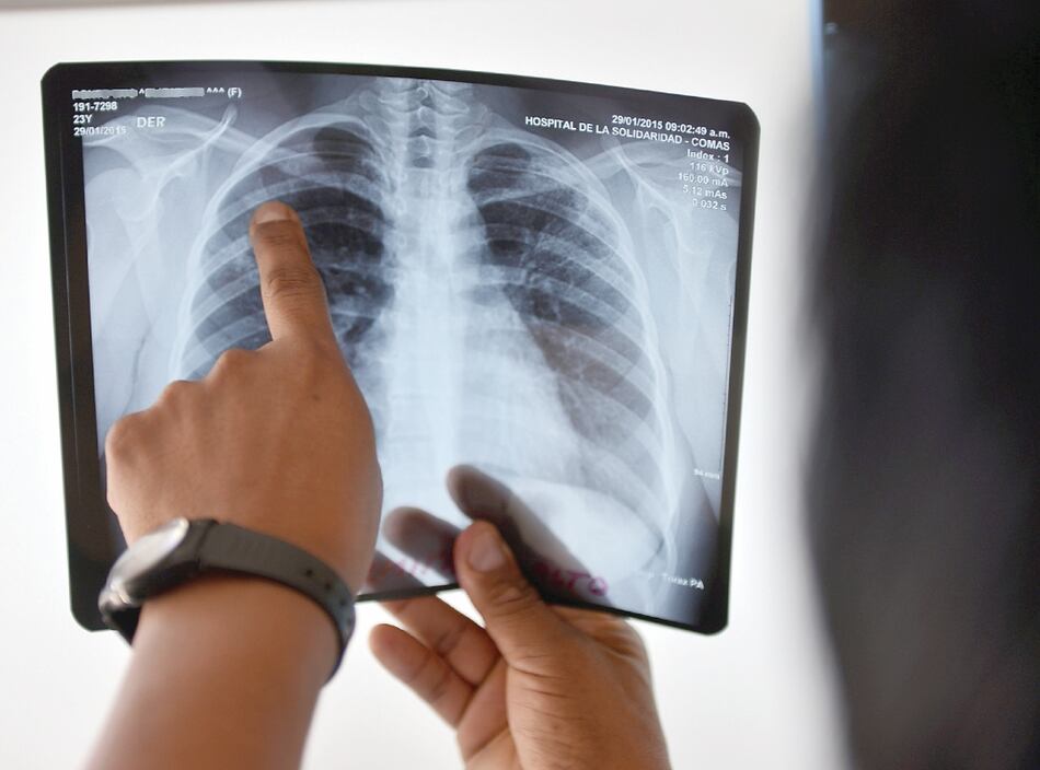 Minsa reporta 46 muertes a causa de la tuberculosis 