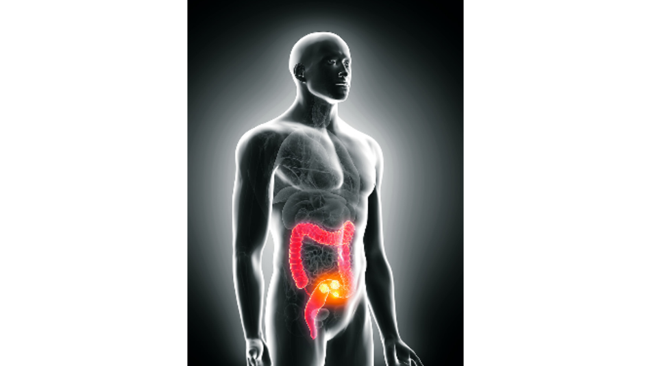 Una luz en el cáncer de colon