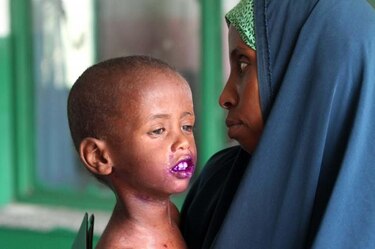 Chad y Somalia, 'peores lugares para los niños que se enferman'