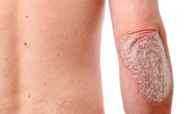 Fundación Psoriasis de Panamá presenta campaña