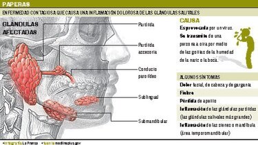 Ministerio de Salud descarta brote de paperas en el país