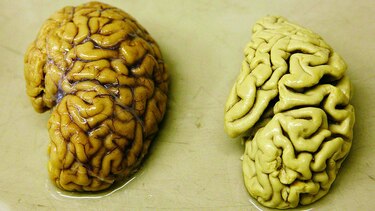Mal de Alzheimer podría transmitirse