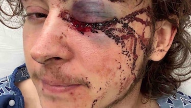 ‘Los médicos dicen que estoy vivo de milagro’: el joven que perdió un ojo durante una protesta contra ICE en California